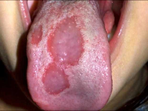 Ожог языка: лечение, степени тяжести, рекомендации, профилактика