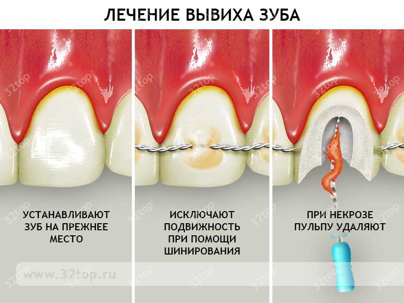 Вывих зуба: причины, симптомы, лечение
