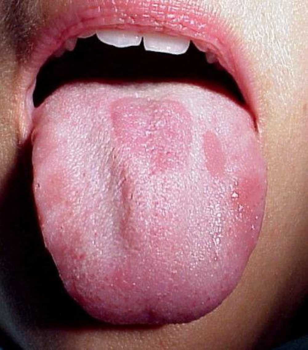 Глоссит языка: причины, симптомы и лечение глоссита языка
