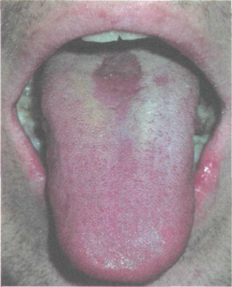 Срединный ромбовидный глоссит Срединный ромбовидный глоссит