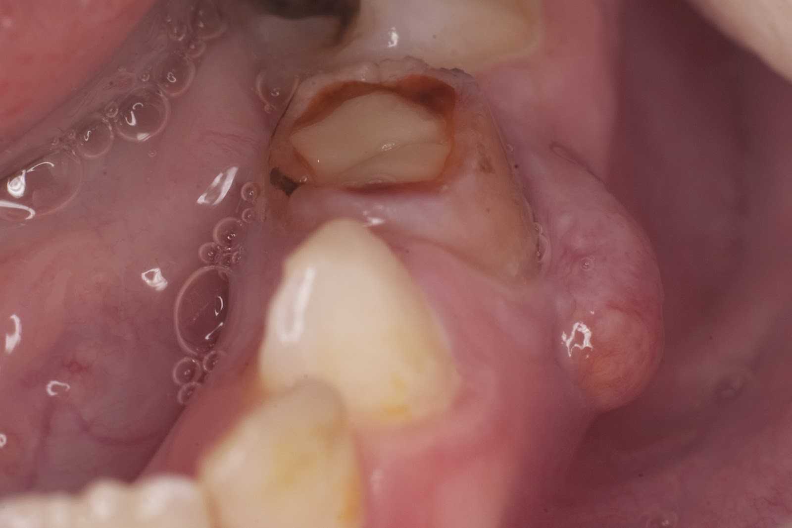 Зуб с периодонтитом
