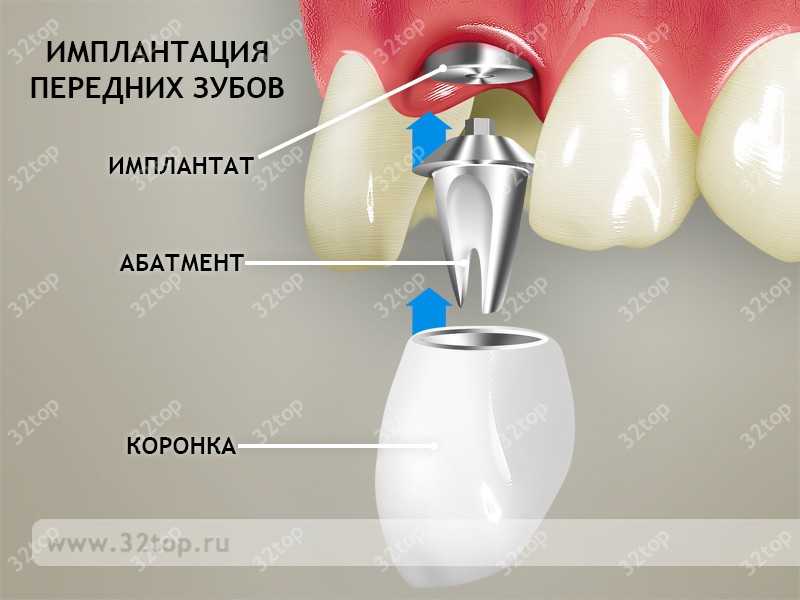 Что случится с зубом, если установить вместо коронки пломбу