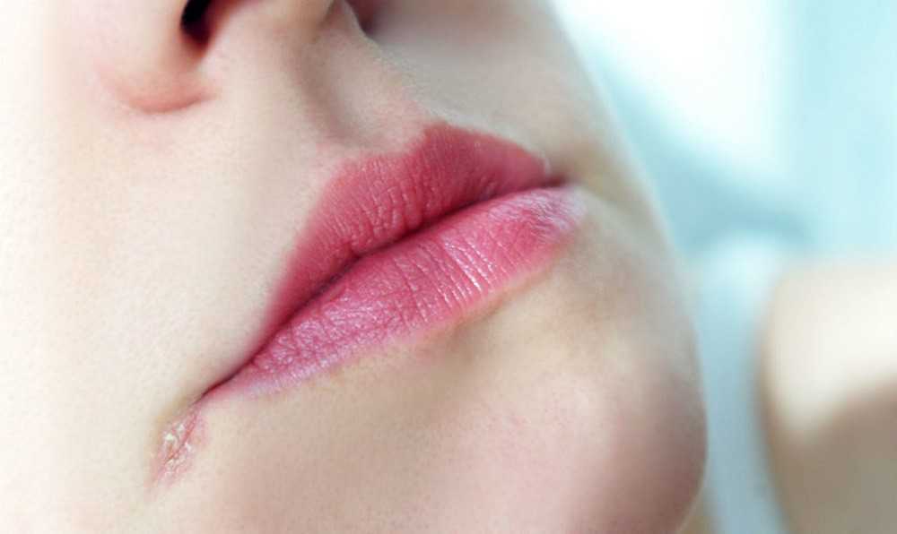 Трещины в уголках рта – лечение лазером