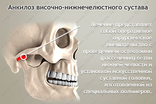 Анкилоз височно-нижнечелюстного сустава причины лечение саркомы тазобедренного сустава