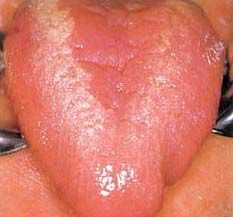 ВИЧ-инфекция в полости рта