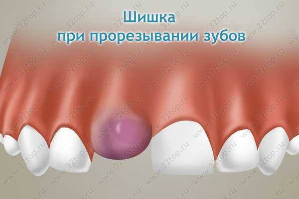 Воспаление на месте прорезывая зуба