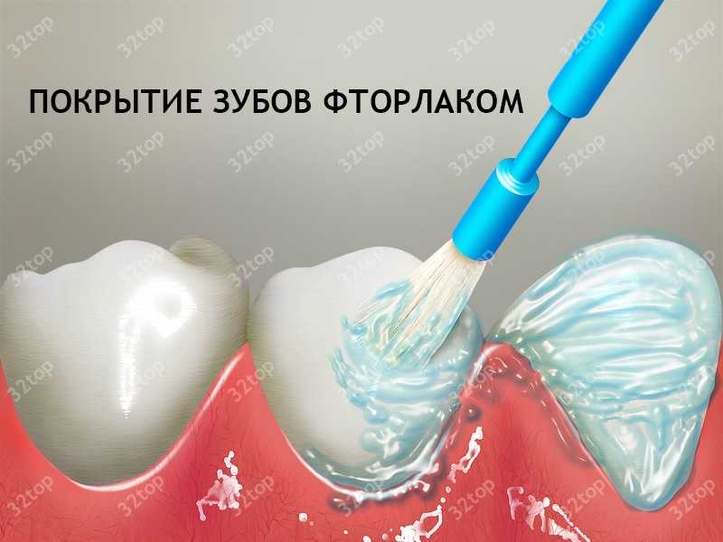 Покрытие зуба защитным лаком Томск Степановская Удаление зуба Томск Нижне-Луговая