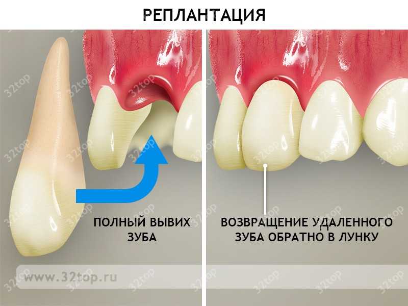 Острая Травма Зубов Классификация Терминология Диагностика