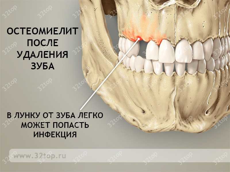 Остеомиелит после удаления зуба