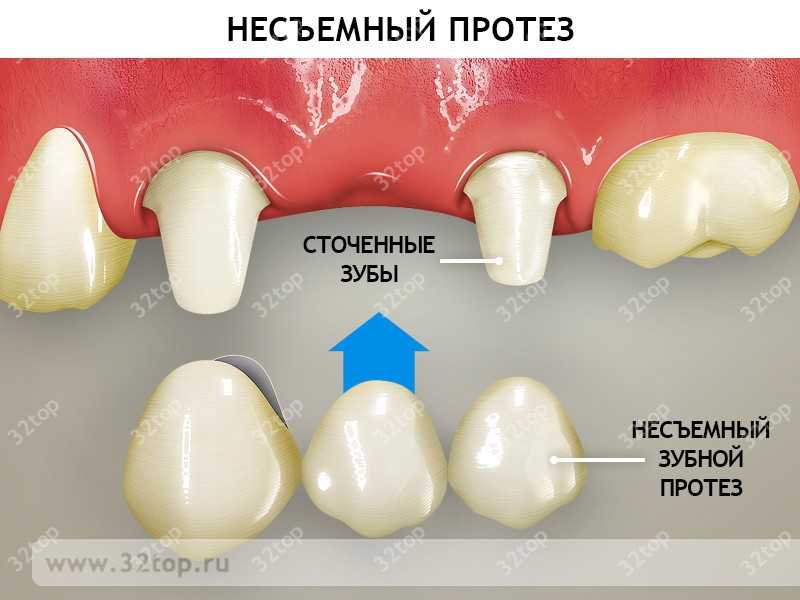 Несъемное протезирование