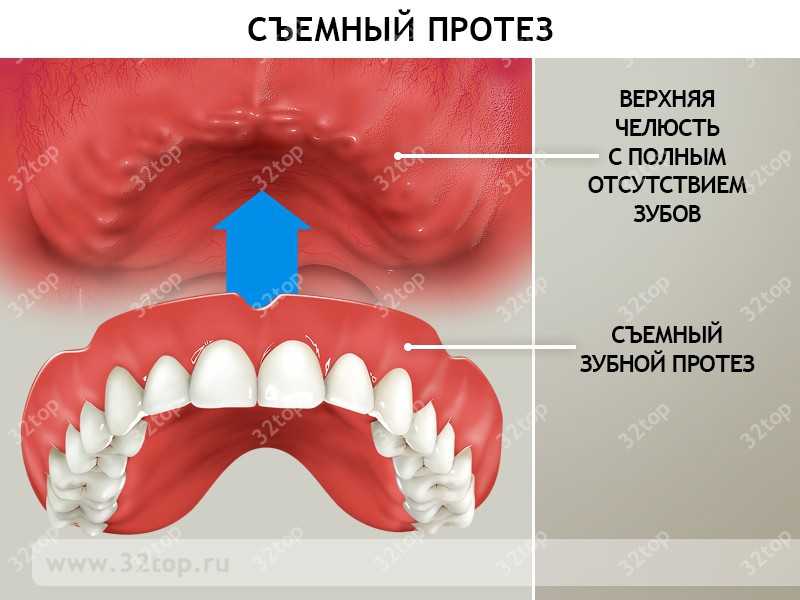 Съемное протезирование