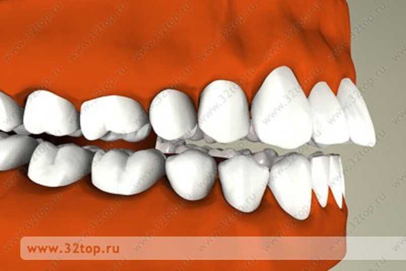 Неправильный прикус