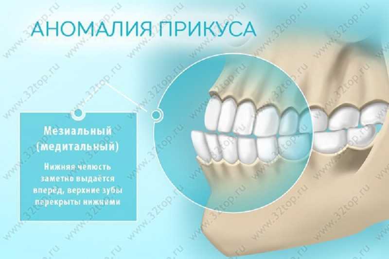 Мезиальный прикус