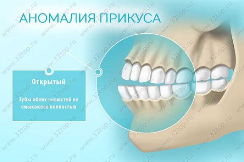 Открытый прикус