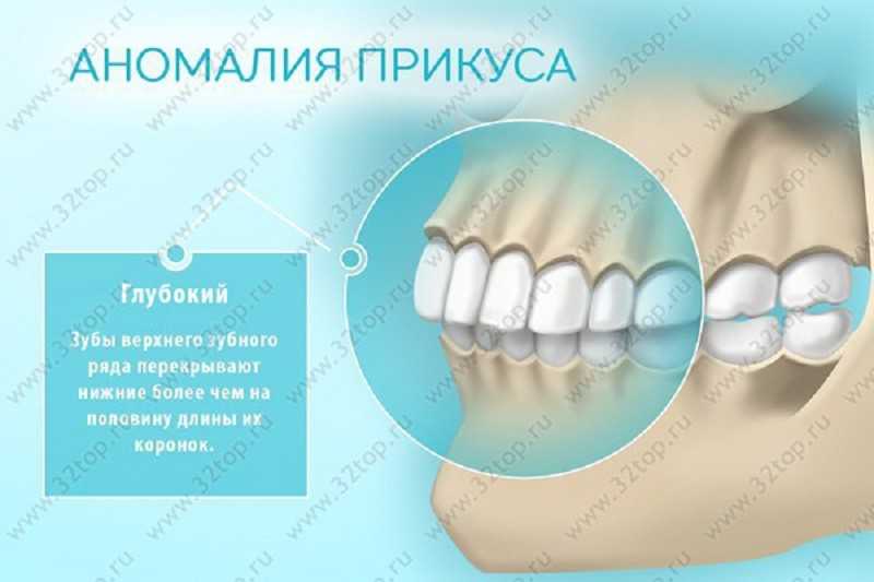 Глубокий прикус