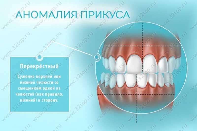 Перекрестный прикус