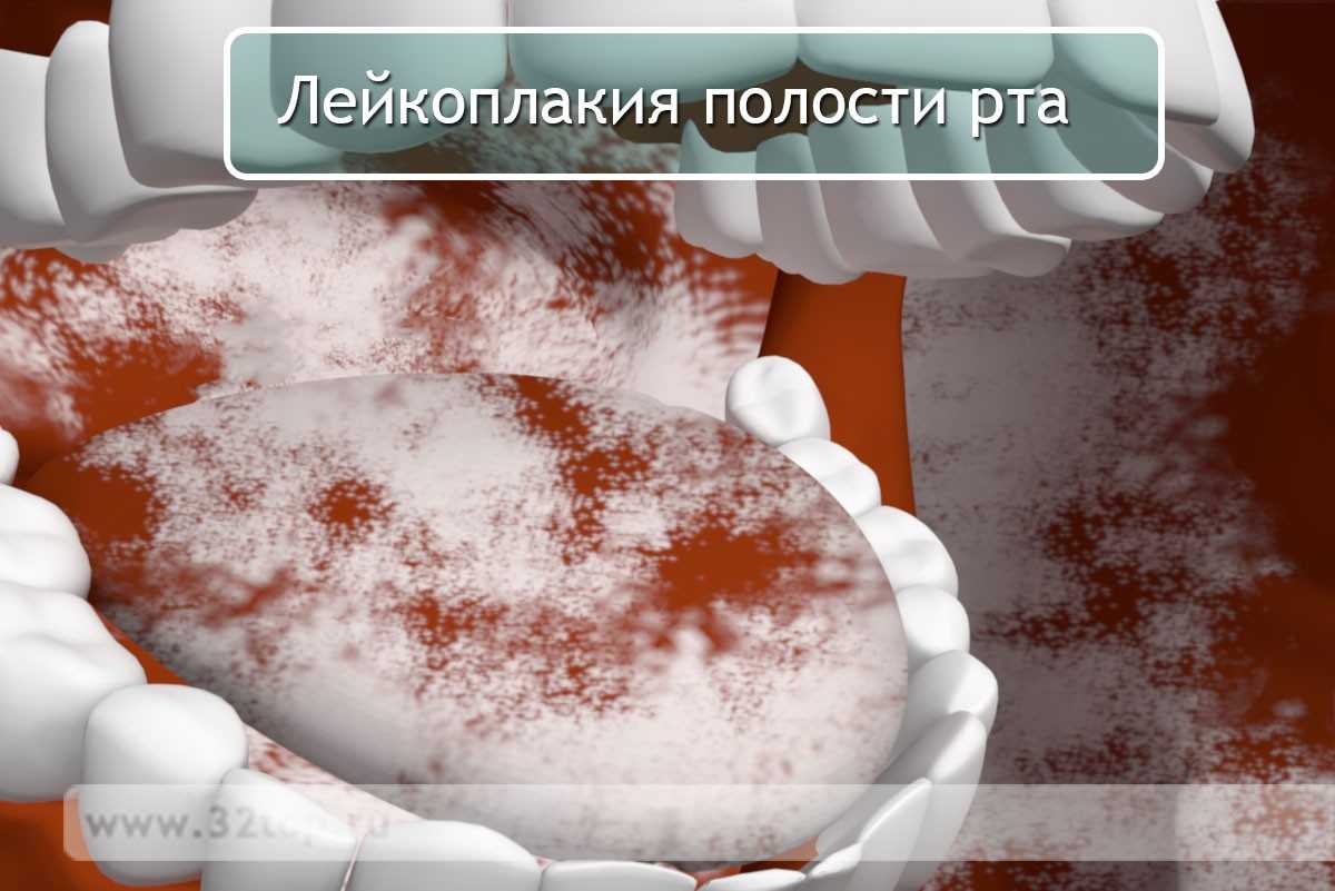 Лейкоплакия полости рта