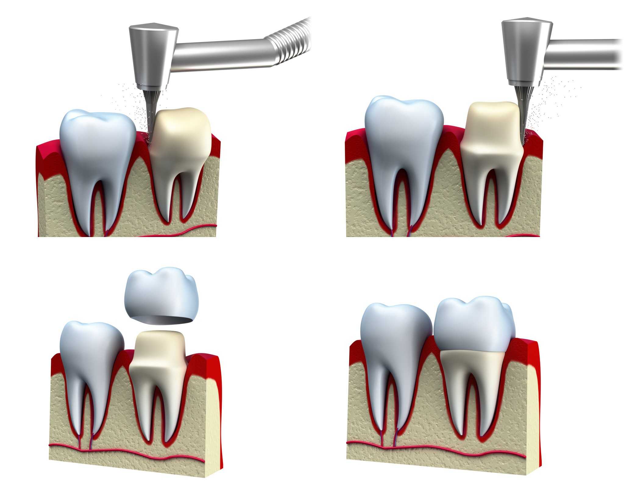 Закаленный зуб. Микропротезы виниры вкладки стоматология. Металлокерамическая Штифтовая коронка. Депульпированный зуб на штифте.