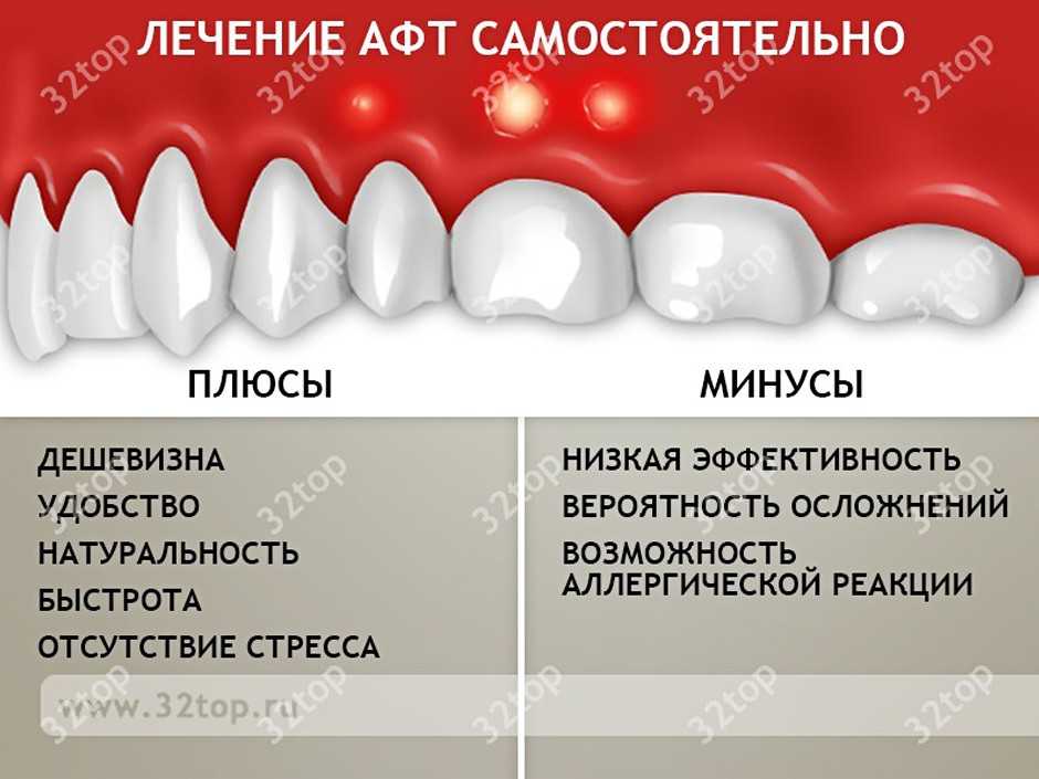 Лечение афт самостоятельно