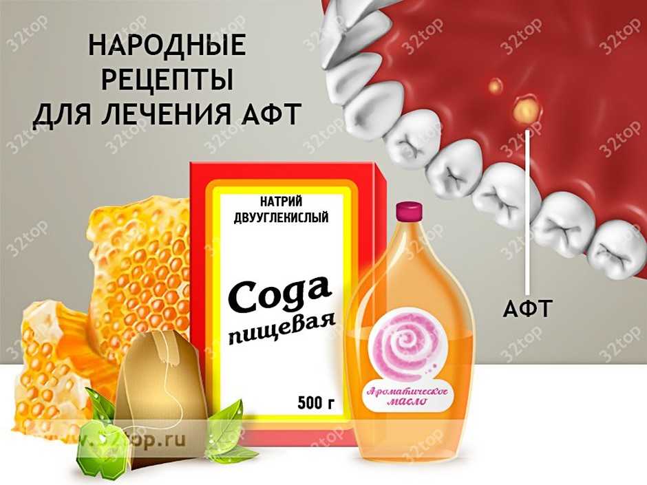 Лечение афт народными средствами