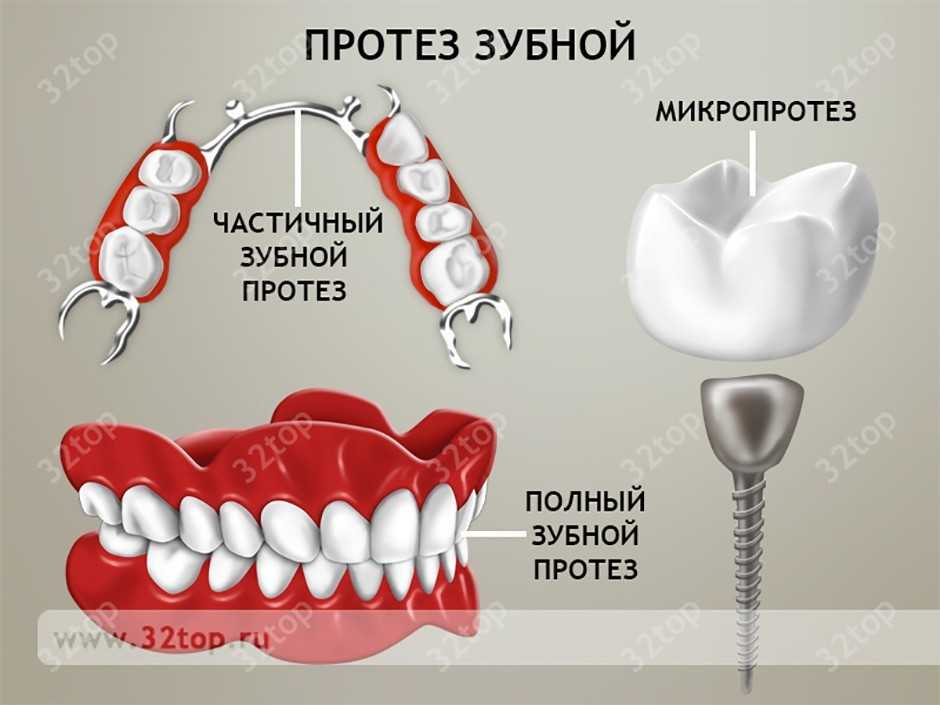 Протезирование зубов схема. Съемные и несъемные зубные протезы классификация. Виды протезов в стоматологии. Виды протезирования зубов схема. Виды протезов. Протезирование зубов схема. Съемные и несъемные зубные протезы классификация. Виды протезов в стоматологии. Виды протезирования зубов схема.