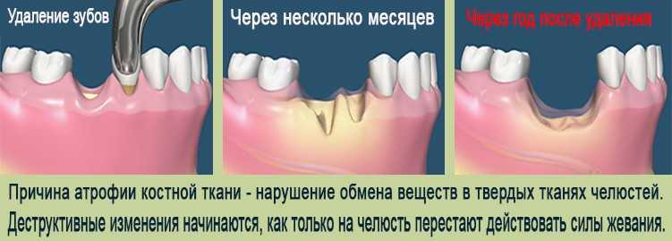 Удаление зуба холод