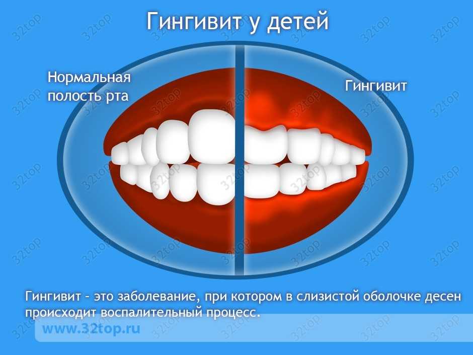 Гингивит или недостаток витамина С - в чем причина кровоточивости десен - Стомат