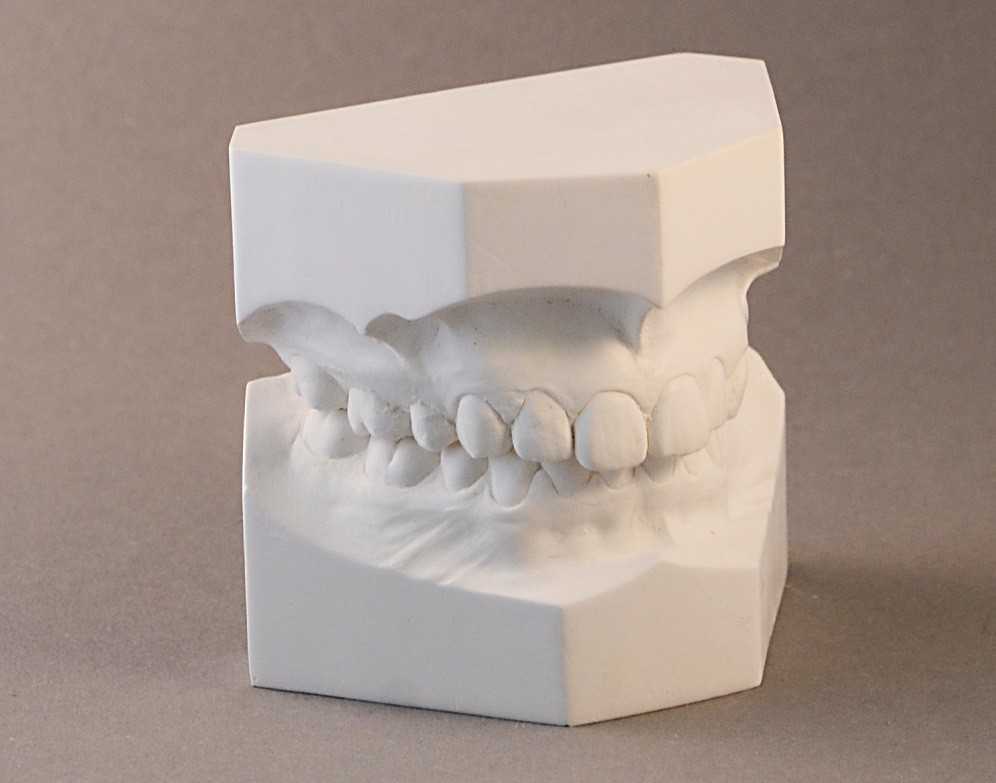 Изготовление гипсовой модели. Гипсовая модель зубов. Гипсовые модели челюстей. Модели стоматологические гипсовые. Гипсовые модели в стоматологии.