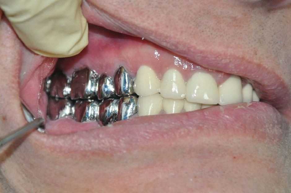 Через сколько можно вставлять зубы. Металлическая коронка. Металлическая коронка на зуб. Металлические зубные коронки. Металлический мостовидный протез.