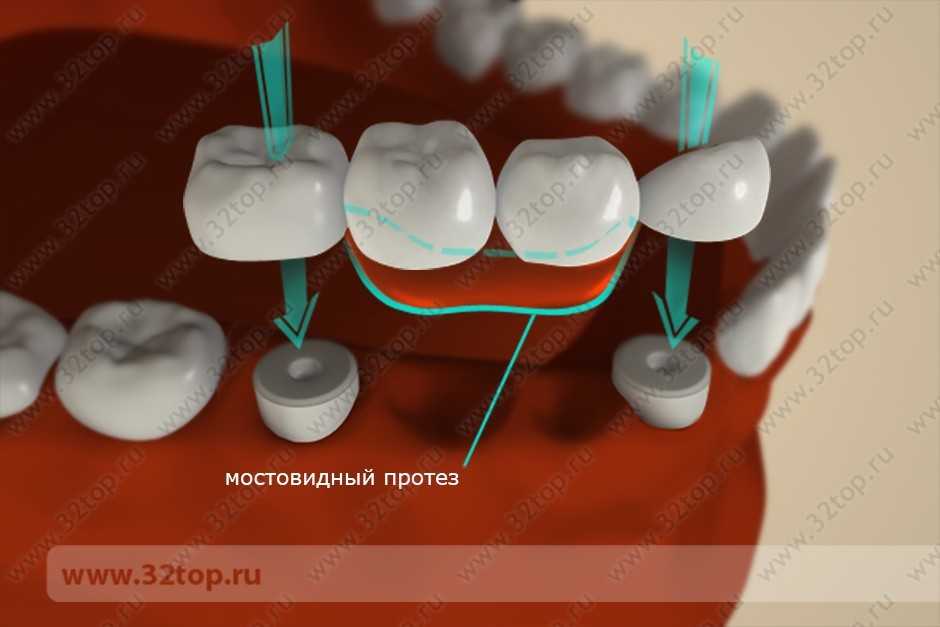 Установка Моста Зубы Стоимость