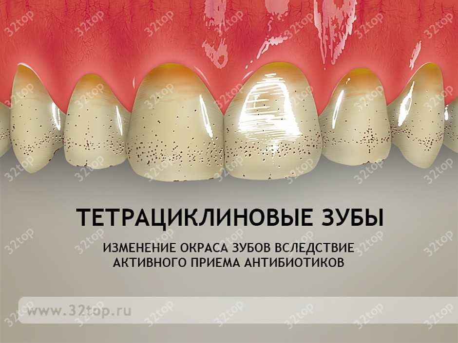 Заболеваниями сходными по клинической картине с гипоплазией эмали являются