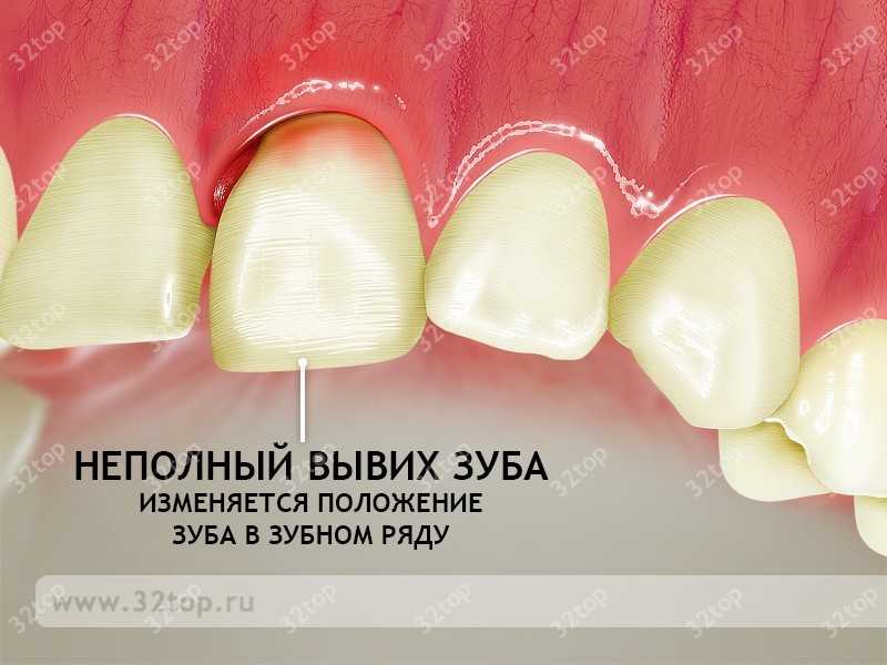 Вправление вывиха (выбитого) зуба в Уфе, т. (347)299-64-64