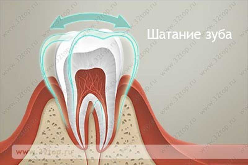 Зуб Шатается Фото