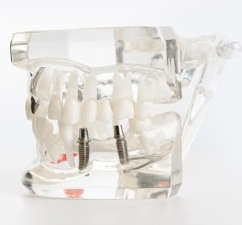 Имплантация зуба под ключ за 48000 рублей!