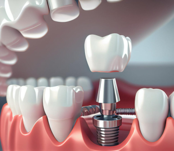 Установка южнокорейского имплантата с формирователем — скидка 10%