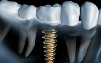 Имплантация под ключ Neodent (Straumann) за 89999 р.