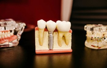 Имплантация Dentium (Ю.Корея) - 34500 руб.