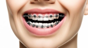 Брекеты на обе челюсти за 150000 рублей!!!