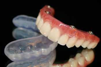 Имплантация 