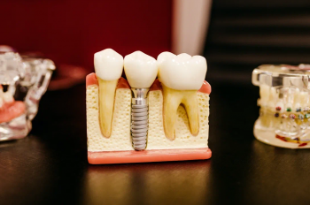 Второй имплантат бесплатно!