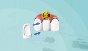 Керамические виниры по низкой цене за 16900 руб!