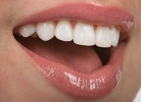 На ранних стадиях трещины зубов легко лечатся